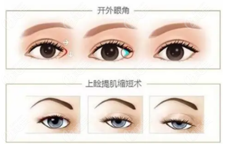 北京双眼皮价格，全面解析与深度探讨