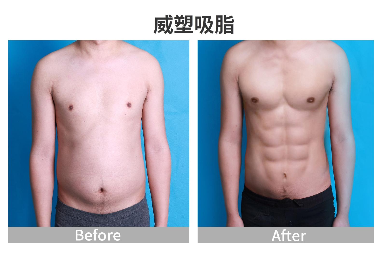 吸脂塑身医院，重塑自信，展现美丽新形象