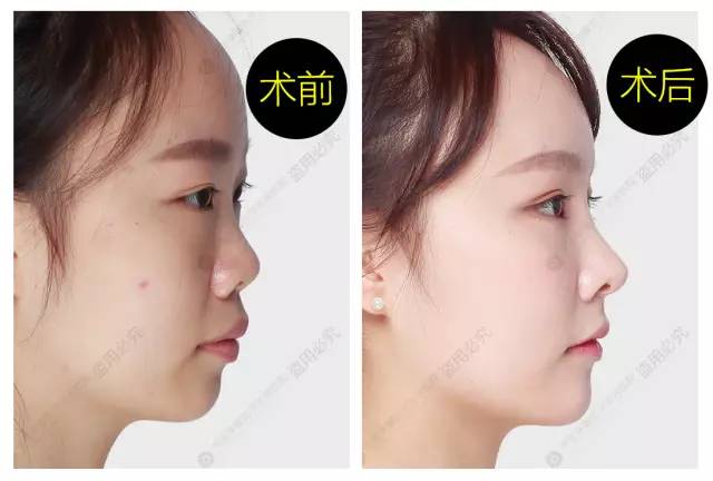 北京隆鼻手术价格，全面解析与深度探讨
