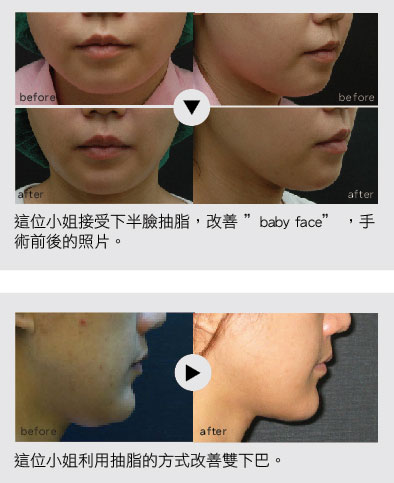 吸脂医院的魅力与重要性，重塑自信与健康的开始之地