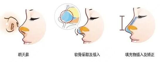 专业隆鼻整形手术，重塑美丽鼻梁的艺术之旅