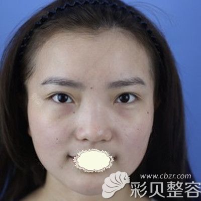 福州隆鼻，重塑美丽，自信闪耀