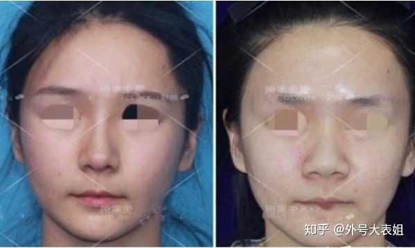 鼻翼缩小手术，探寻最佳之选