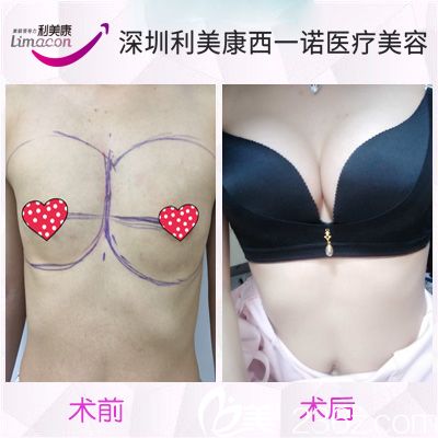 北京隆胸整形医院，专业塑造美丽曲线