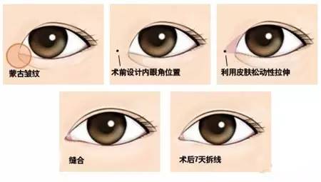 双眼皮塑造美丽，探寻最佳割双眼皮手术地点