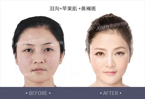 安徽整形，重塑美丽的艺术之旅