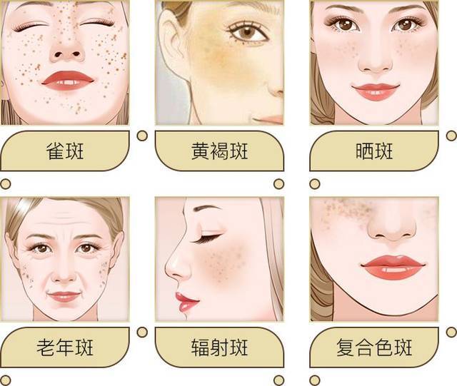激光祛斑哪里最好？专业美容机构的选择与优势分析
