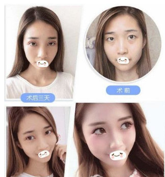双眼皮塑造，寻找最好的医院