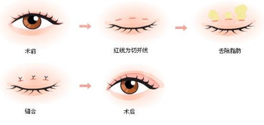 双眼皮手术，如何选择最佳的割双眼皮医院
