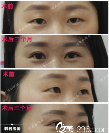 双眼皮手术，寻找最好的医院