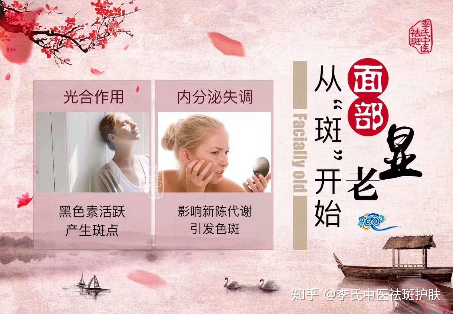祛斑专家，专业解析色斑成因与有效祛斑方法