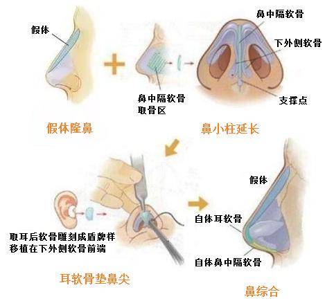 如何选择，哪家医院的隆鼻手术最佳？