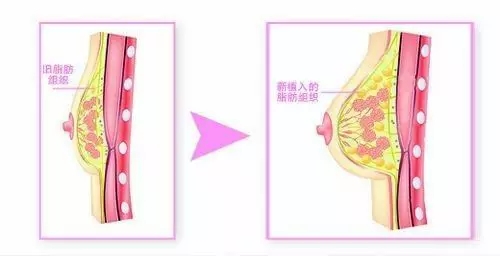 自体脂肪隆胸专家，塑造完美曲线的艺术大师