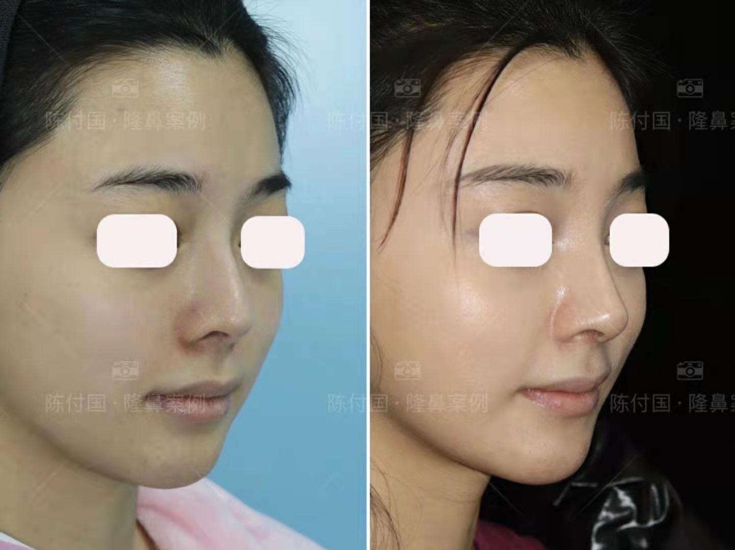 鼻孔整形美容，探索与理解