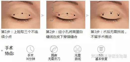 双眼皮埋线手术，探寻最佳之选