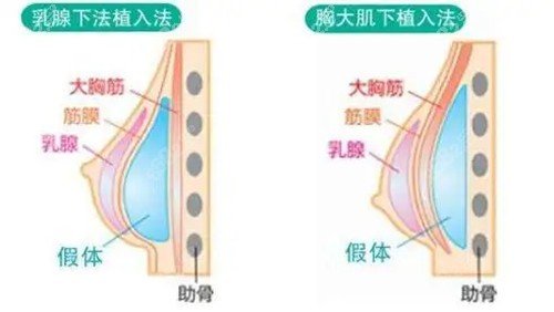 专业塑造美丽曲线（或胸部整形