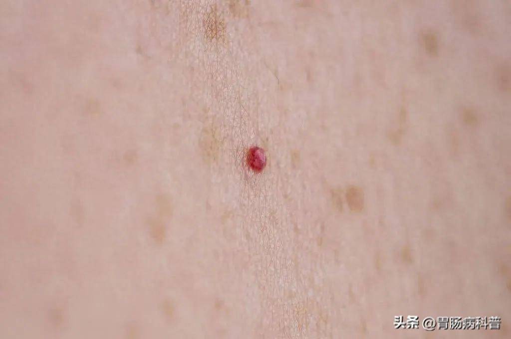 身上起小红点，原因、诊断与治疗方法